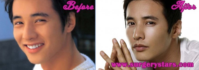 Won Bin Plastic Surgery