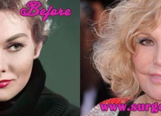 kim Novak plastic surgery