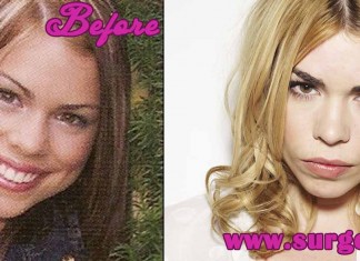 Billie Piper Plastic Surgery l