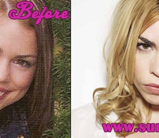 Billie Piper Plastic Surgery l