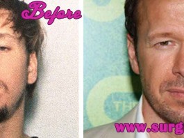 Donnie Wahlberg plastic surgery