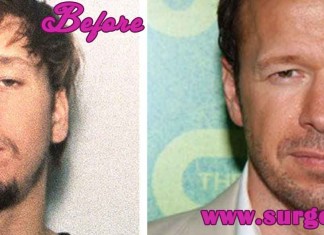 Donnie Wahlberg plastic surgery