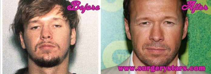 Donnie Wahlberg plastic surgery