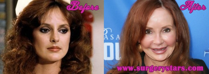 Jackie Zeman Plastic Surgery