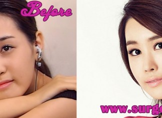 Lee Da Hae Plastic Surgery