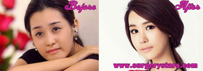 Lee Da Hae Plastic Surgery