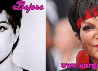 Liza Minnelli Plastic Surgery