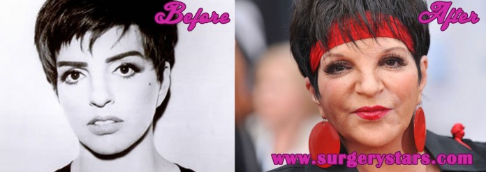 Liza Minnelli Plastic Surgery