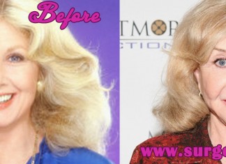 Michael Learned Plastic Surgery