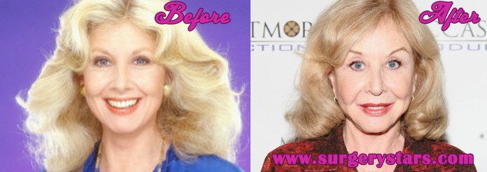 Michael Learned Plastic Surgery