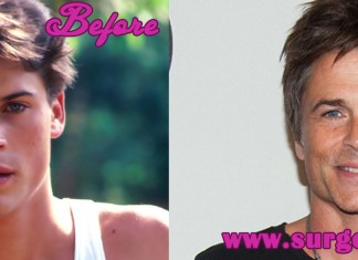 Rob Lowe Plastic Surgery