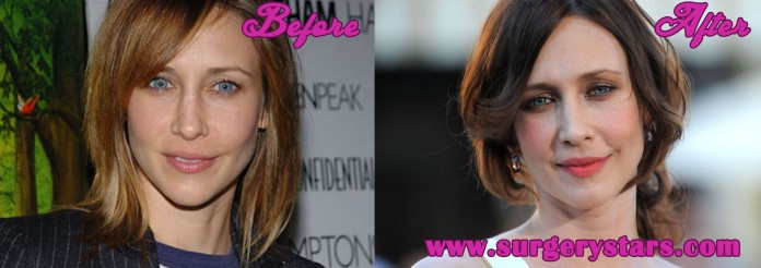 Vera Farmiga Plastic Surgery