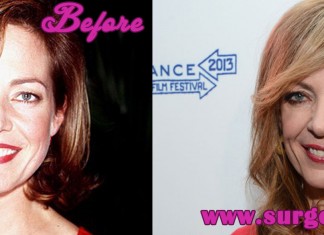 Allison Janney Plastic Surgery