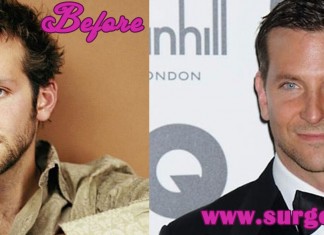 Bradley Cooper Plastic Surgery