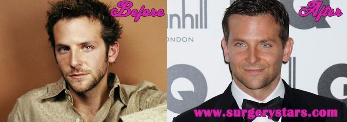 Bradley Cooper Plastic Surgery