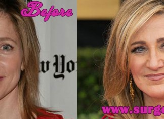 Edie Falco Plastic Surgery