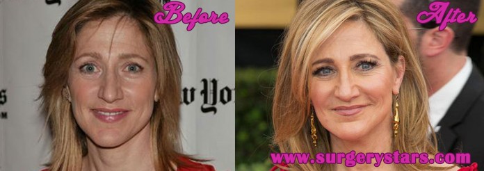 Edie Falco Plastic Surgery