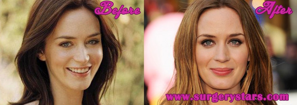 Emily Blunt Plastic Surgery