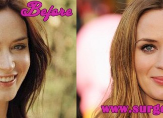 Emily Blunt Plastic Surgery