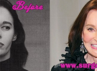 Gloria Vanderbilt Plastic Surgery