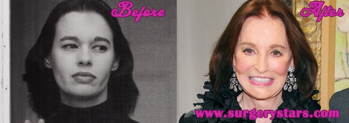 Gloria Vanderbilt Plastic Surgery