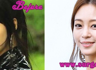 Han Ye Seul Plastic Surgery