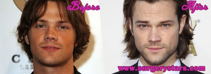 Jared Padalecki Nose Job