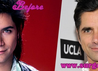 John Stamos Plastic Surgery