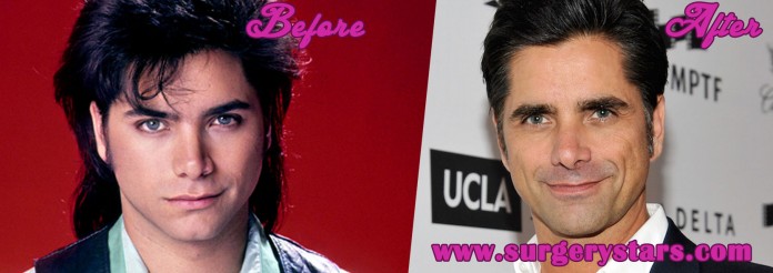 John Stamos Plastic Surgery