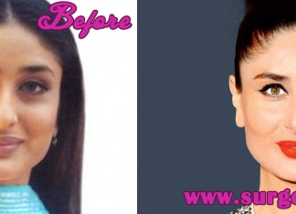 Kareena Kapoor Plastic Surgery