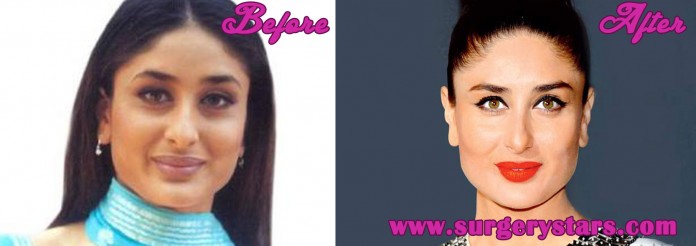 Kareena Kapoor Plastic Surgery