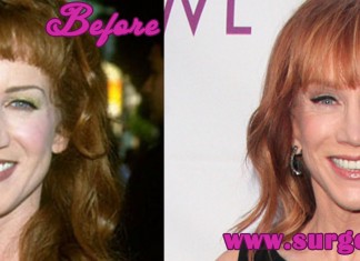 Kathy Griffin Plastic Surgery