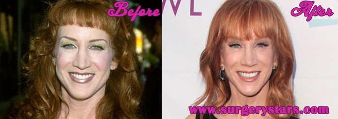 Kathy Griffin Plastic Surgery