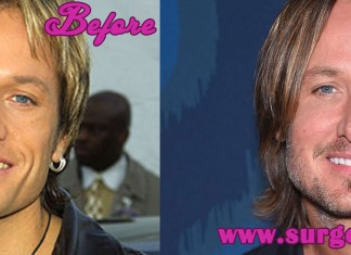 Keith Urban Plastic Surgery