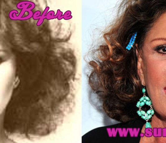 Lainie Kazan Plastic Surgery