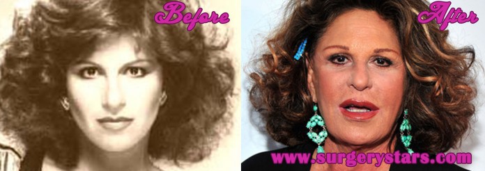 Lainie Kazan Plastic Surgery