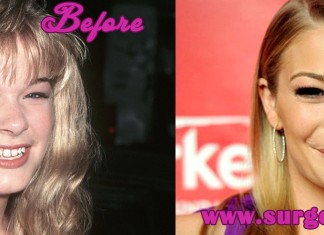 Leann Rimes Plastic Surgery