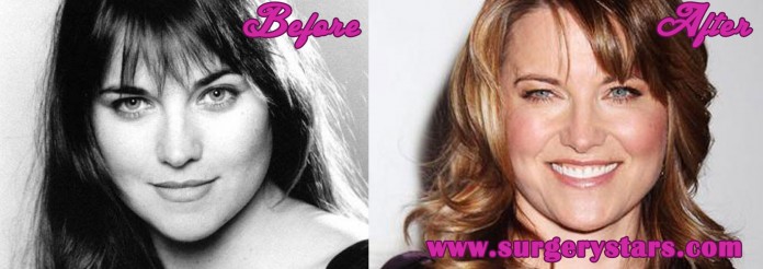 Lucy Lawless Plastic Surgery