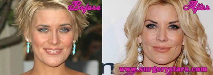 Mckenzie Westmore Plastic Surgery Before and After