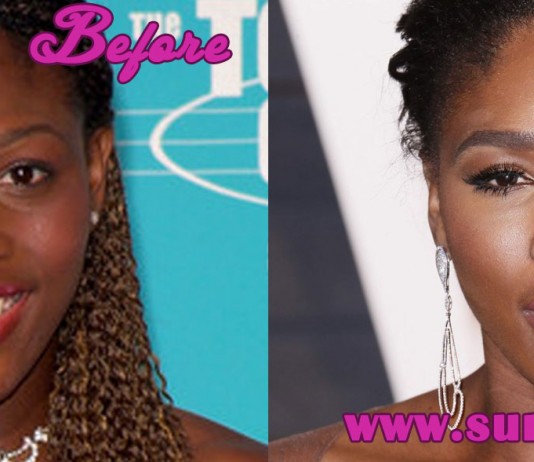 Serena Williams Plastic Surgery