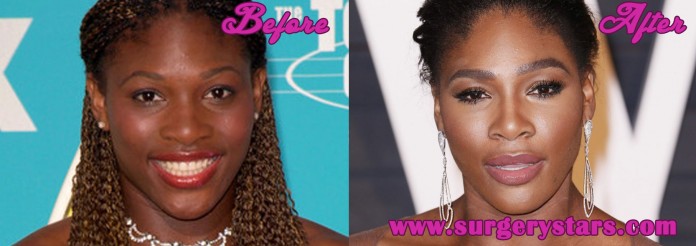 Serena Williams Plastic Surgery