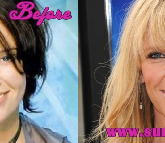 Toni Collette Plastic Surgery