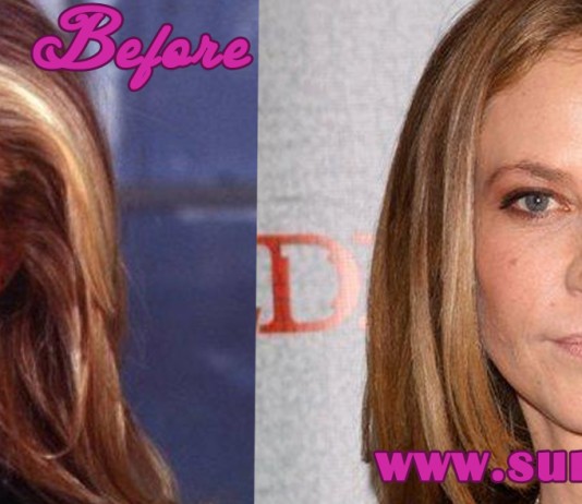 Ally Walker Plastic Surgery