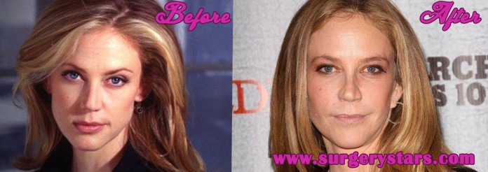 Ally Walker Plastic Surgery