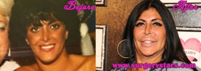 big ang plastic surgery