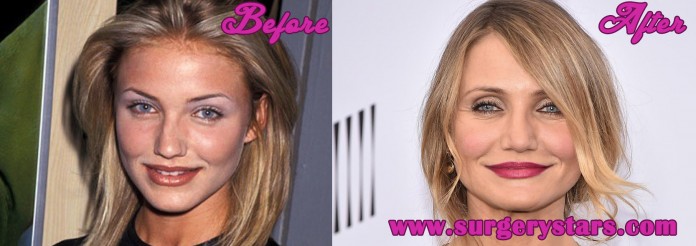 Cameron Diaz Plastic Surgery