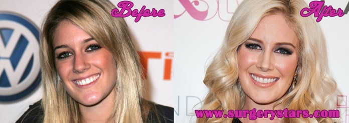 heidi montag plastic surgery