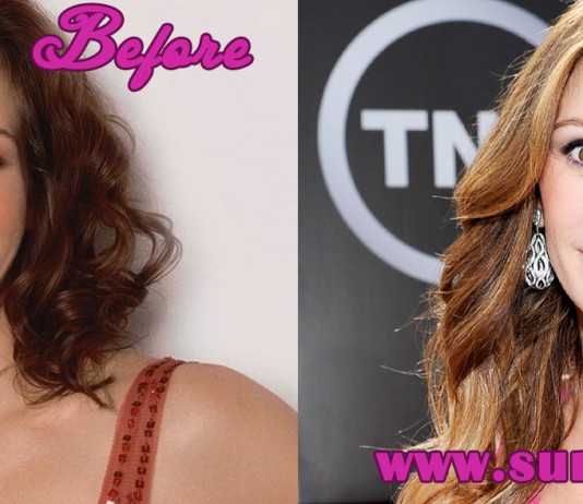 julia roberts plastic surgery
