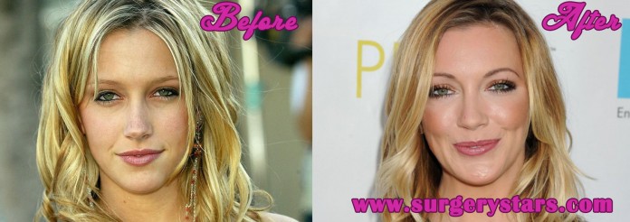 katie cassidy plastic surgery