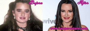 Kyle Richards Plastic Surgery Before and After Pictures